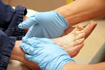 When to Consider Foot Callus Removal, Podiatrist located in Fort Worth, TX