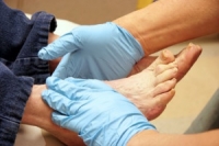 How Diabetes Can Affect the Feet