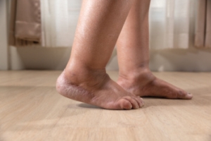Causes of Swollen Feet