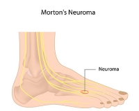 Possible Relief Methods From Morton’s Neuroma