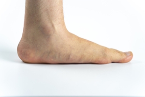 How to Identify Flat Feet