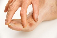 Why Do Bunions Develop?