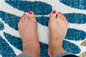 Causes of Swollen Feet and Ankles