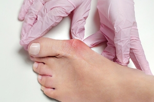How to Relieve Pain From Bunions