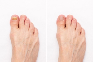 When Oral Treatment Is Used for Toenail Fungus