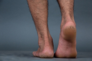Cracked Heels and Vitamin Deficiencies