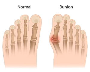 Bunions and Foot Joint Health