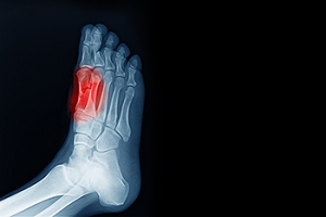 Sesamoiditis Causes and Symptoms