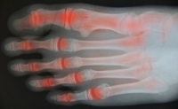 How to Reduce Pain and Spot Warning Signs of Arthritis in Your Feet