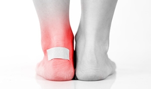 Preventing Blisters While Running