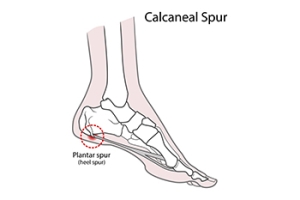 Are Heel Spurs Causing Your Heel Pain?