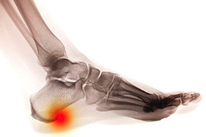 Do I Have a Heel Spur?